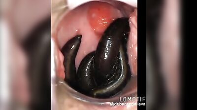 leeches in pussy