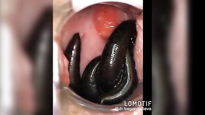 leeches in pussy