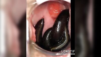 leeches in pussy
