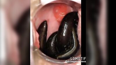 leeches in pussy